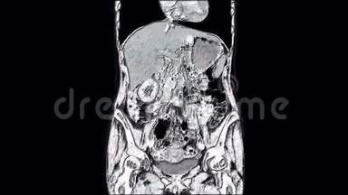 腹腔、胃肠道、膀胱的MRI对比
